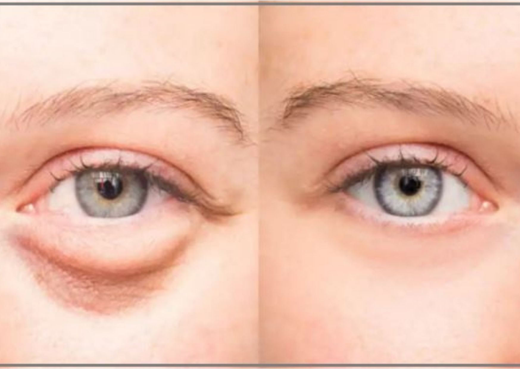 What Do Your Eye Bags Tell About Your Health | जानिए आपकी आईबैग आपके  स्वास्थ्य के बारे में क्या बताती हैं?